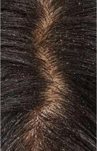 Customer-submitted close-up scalp and hair appearance before continued use